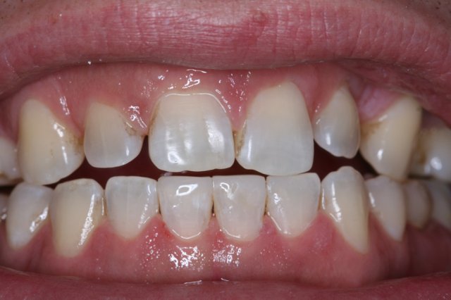 Lower Chipped Tooth After